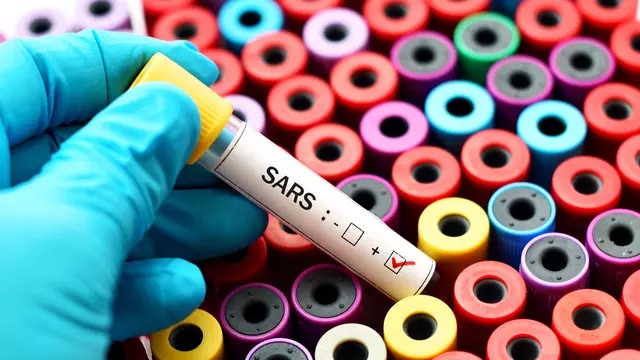 Virus MERS dan SARS, Virus Corona Wuhan Dinilai Tidak Mematikan