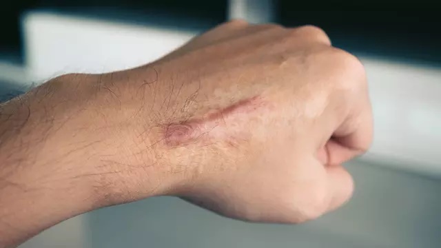 Menghilangkan Keloid di Kulit dengan Aman