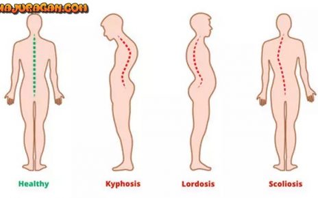 Beda Kelainan Tulang Skoliosis, Kifosis, dan Lordosis