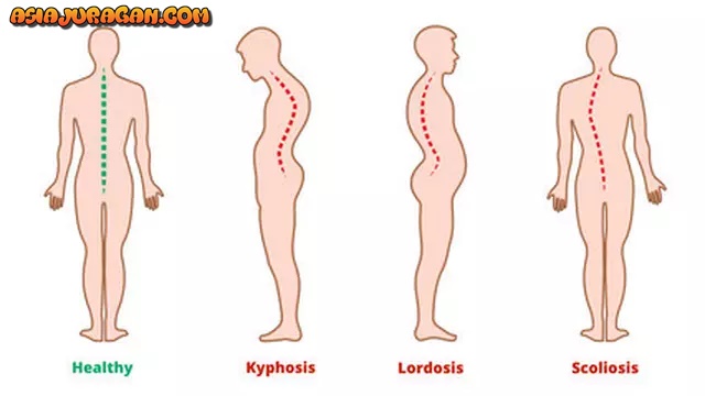 Beda Kelainan Tulang Skoliosis, Kifosis, dan Lordosis