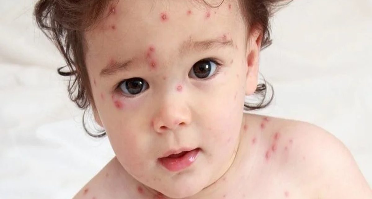 6 Gejala dan Penyebab Impetigo Pada Anak, Ibu Harus Tahu