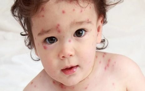 6 Gejala dan Penyebab Impetigo Pada Anak, Ibu Harus Tahu