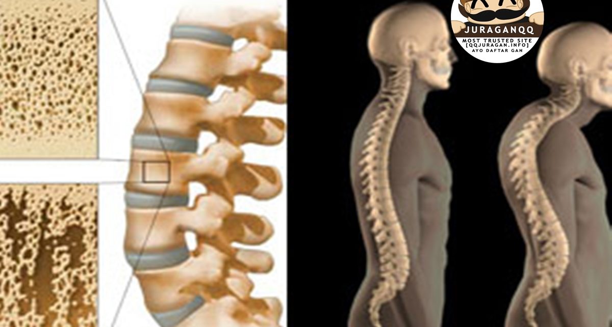 Karena Gaya Hidup, 5 Penyebab Osteoporosis yang Harus Kamu Hindari