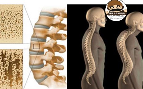 Karena Gaya Hidup, 5 Penyebab Osteoporosis yang Harus Kamu Hindari