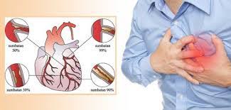 Penyakit Jantung Koroner | Kemenkes RS ...