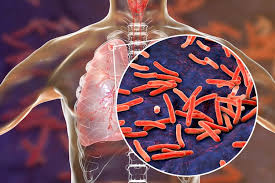 Penyakit Tuberkulosis - Gejala, Penyebab, Pengobatan - Kompas.com