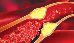 Kolesterol berkait penyakit jantung